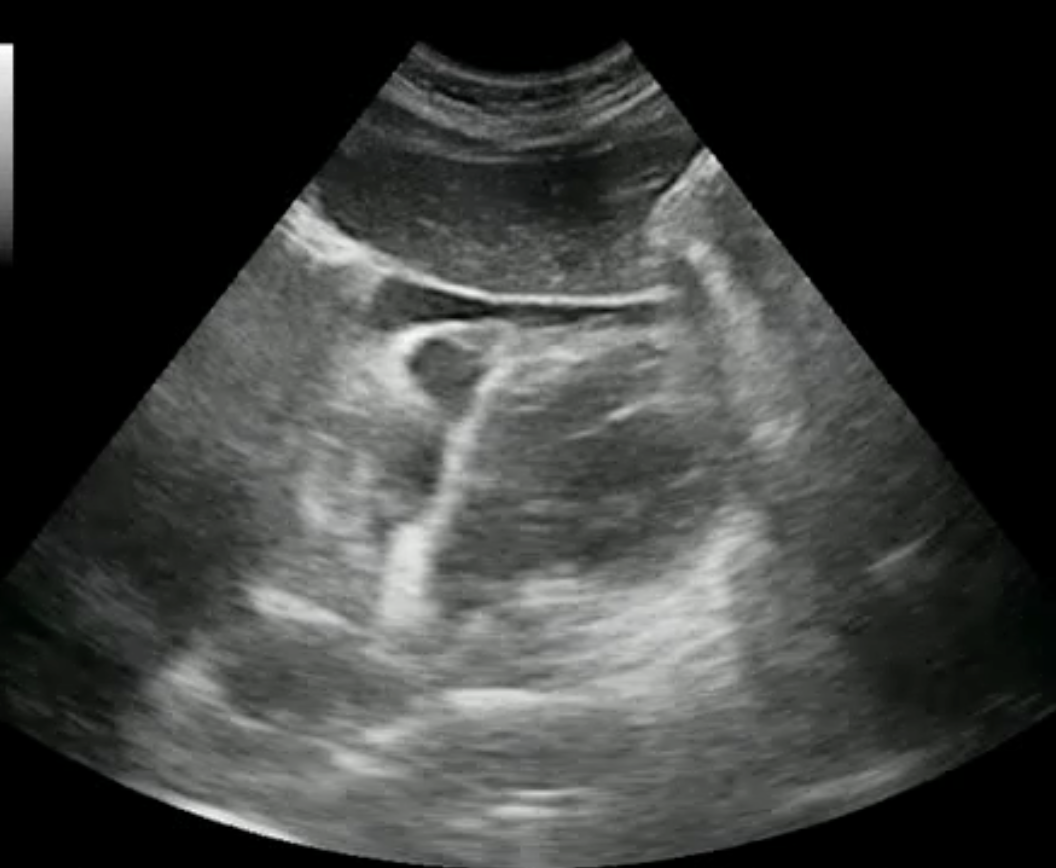 subcostal cardiac window